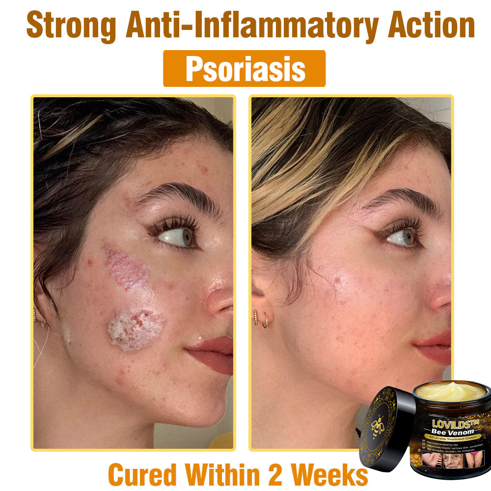 LOVILDS™ Bee Venom Cream — Trusted by Millions for Healthy, Glowing Skin