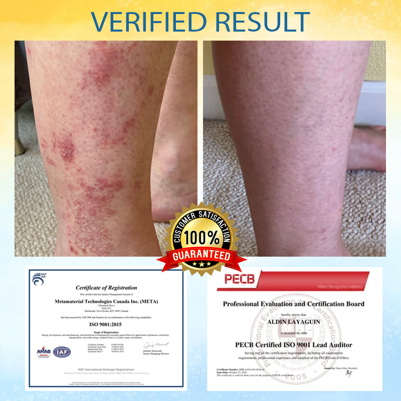 LOVILDS® Psoriasis Care Mellifera Venom Skin Healing Spray🔥