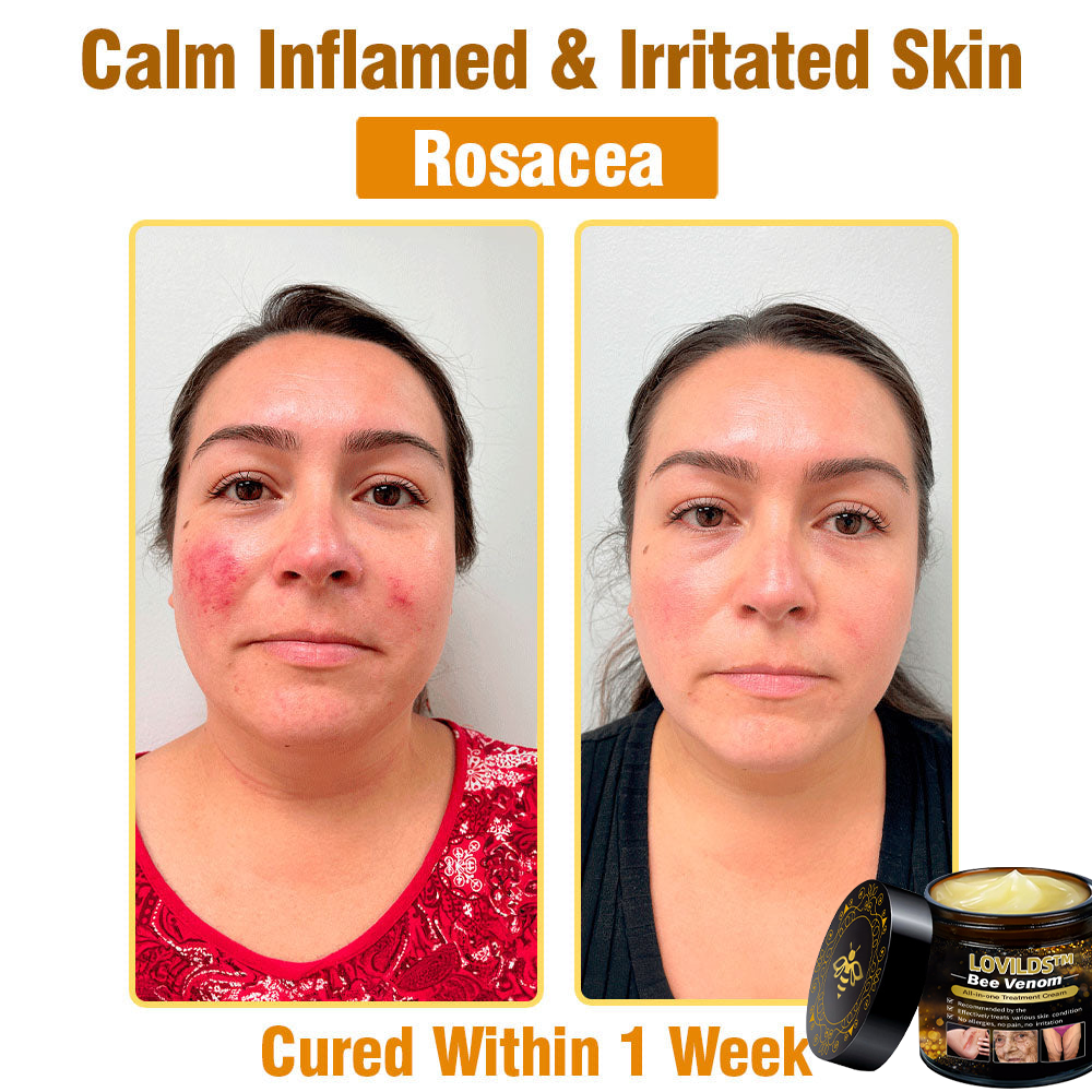 LOVILDS™ Bee Venom Cream — Trusted by Millions for Healthy, Glowing Skin